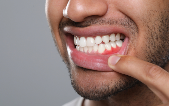 mouth breathing and gum disease